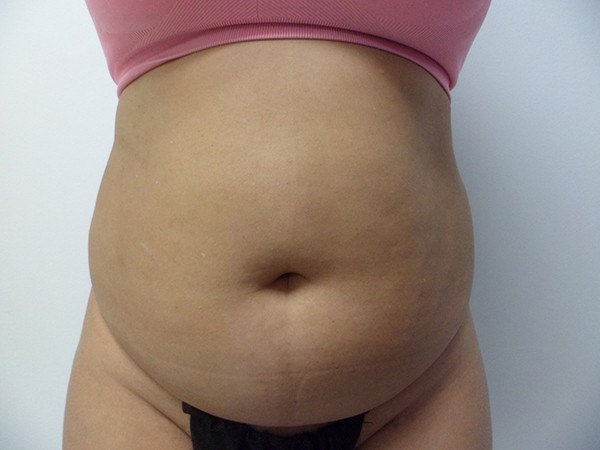 Quantum Abs Before & After Patient #3113
