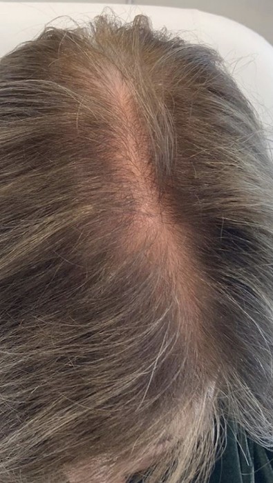 Hair Loss Treatment Before & After Patient #3245