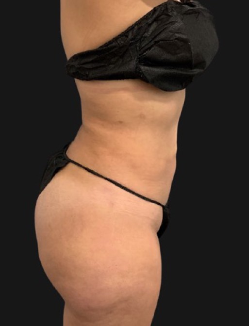 Brazilian Butt Lift Before & After Patient #3381