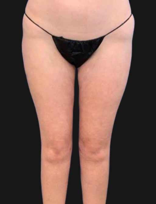 Quantum Thighs Before & After Patient #3433