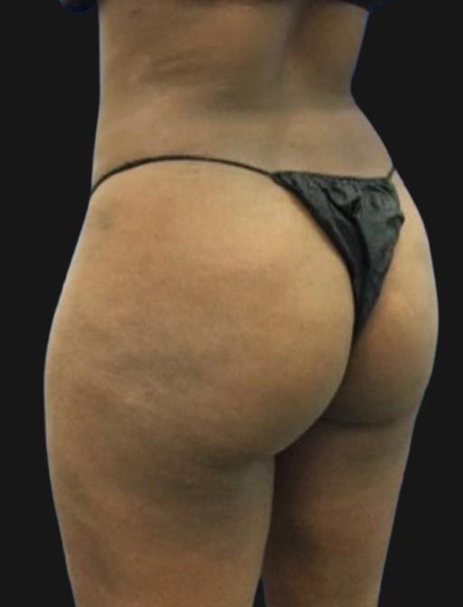 Brazilian Butt Lift Before & After Patient #3384