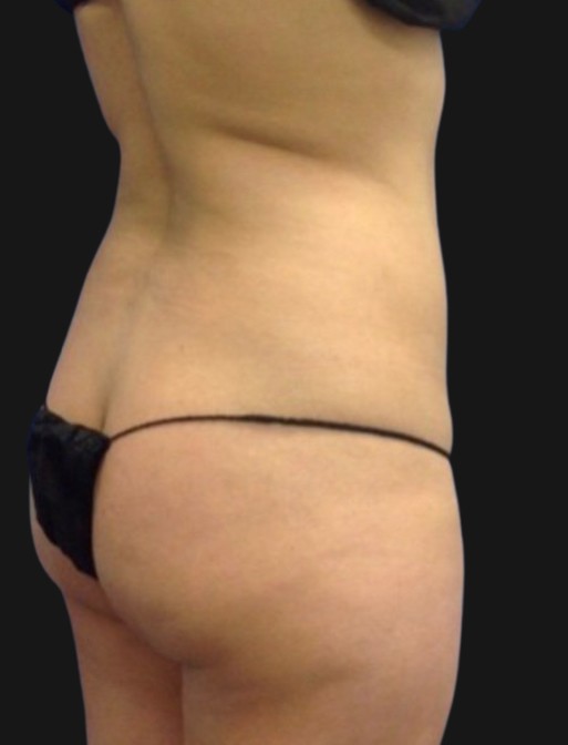 Brazilian Butt Lift Before & After Patient #3393