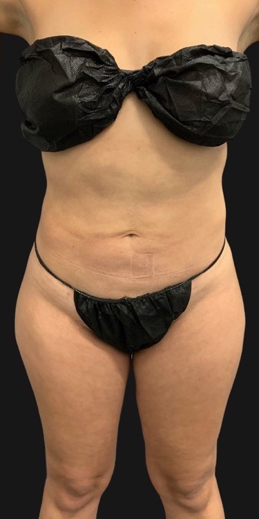 Quantum Abs Before & After Patient #3416