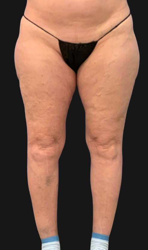 Quantum Thighs Before & After Patient #3560