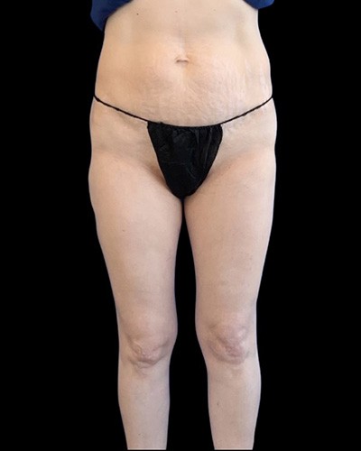 Quantum Thighs Before & After Patient #3592