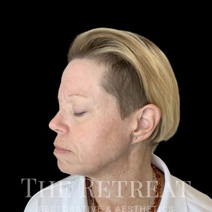 Chemical Peels Before & After Patient #3600