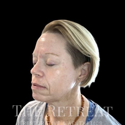 Chemical Peels Before & After Patient #3600