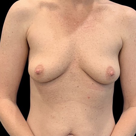 Fat Transfer to Breast Before & After Patient #3603