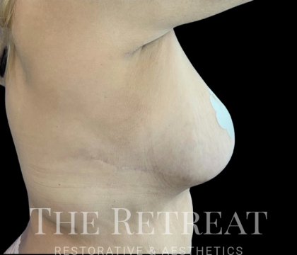 Fat Transfer to Breast Before & After Patient #3646