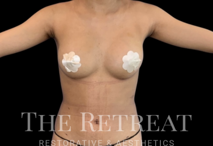 Fat Transfer to Breast Before & After Patient #3649