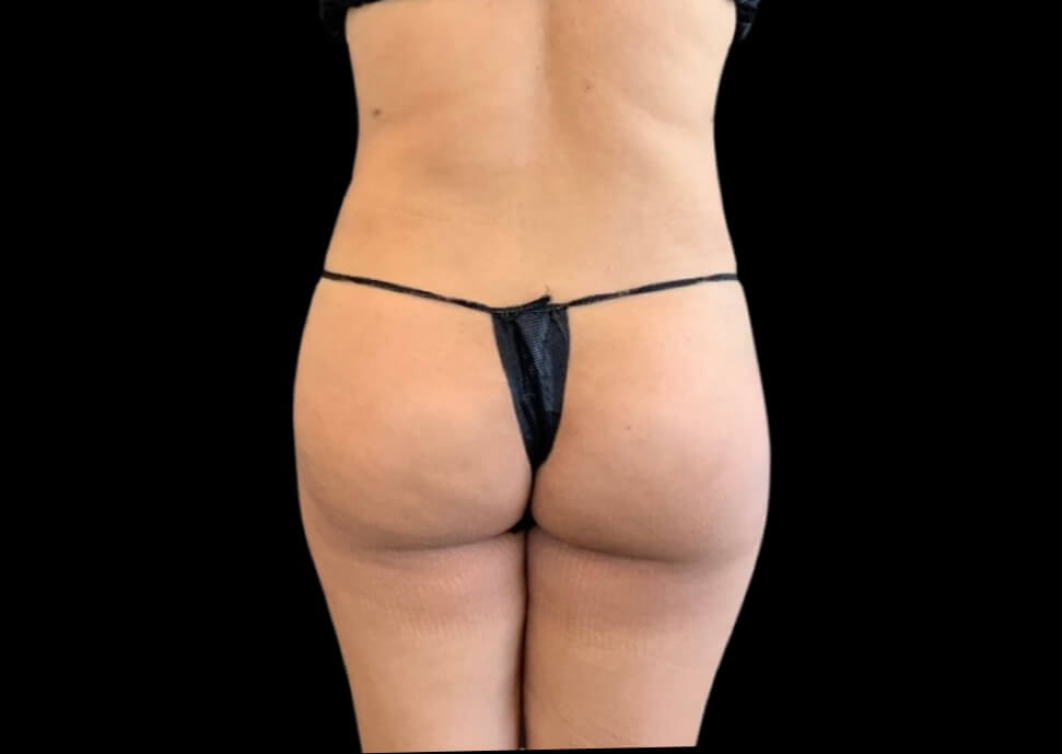 Hip Dip Fill-ins Before & After Patient #3728