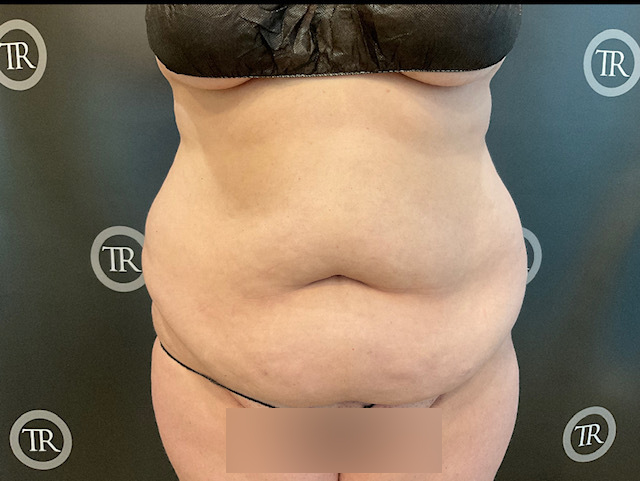 Quantum Abs Before & After Patient #3760