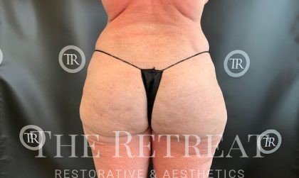 Hip Dip Fill-ins Before & After Patient #3878