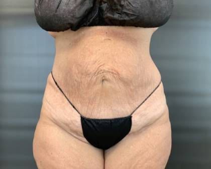 Quantum Abs Before & After Patient #3973