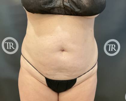 Quantum Abs Before & After Patient #3972