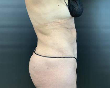 Quantum Abs Before & After Patient #3978