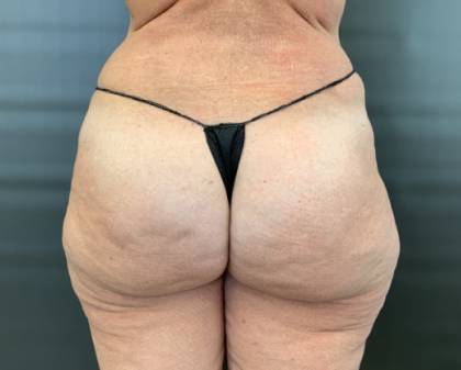 Brazilian Butt Lift Before & After Patient #3983