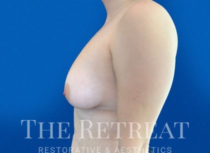 Fat Transfer to Breast Before & After Patient #4036