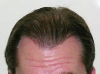FUE Hair Transplant Before & After Patient #4169