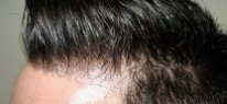 FUE Hair Transplant Before & After Patient #4168