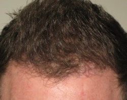 FUE Hair Transplant Before & After Patient #4160