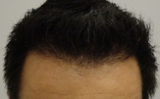 FUE Hair Transplant Before & After Patient #4161