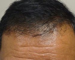 FUE Hair Transplant Before & After Patient #4162