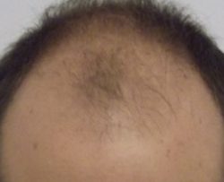 FUE Hair Transplant Before & After Patient #4167